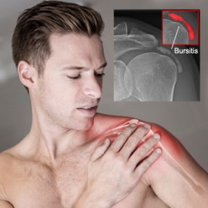 shoulder-bursitis-s2-signs-symptoms-diagnosed