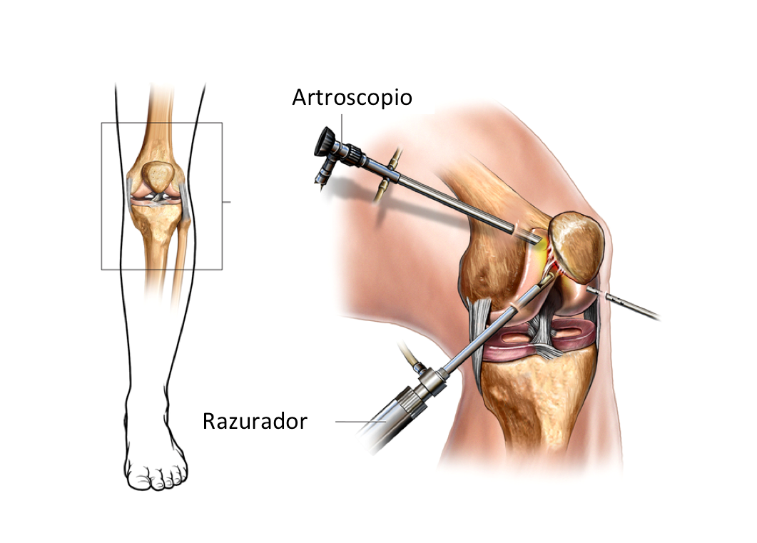 Восстановление сустава без операции. Артроскопический артролиз коленного сустава. Операция артроскопия коленного. Разрыв мениска артроскопия.