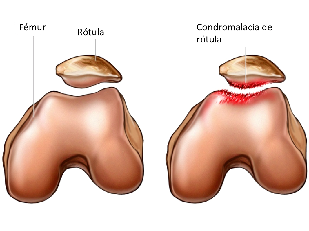 condro CONDROPATIA O CONDROMALACIA ROTULIANA, ¿QUÉ ES?