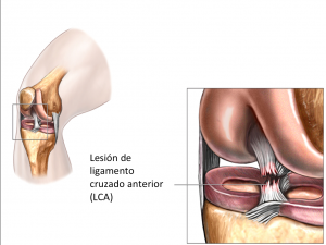 lesión de ligamento cruzado anterior