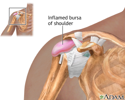 Bursitis De Hombro Traumatologo